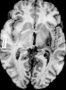 Organized putaminal hemorrhage